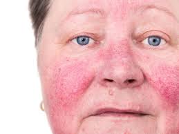Rosacea