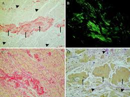Cardiac amyloidosis occurs when plaques of protein byproduct called amyloid build up in heart muscle, affecting its ability to pump blood. Cardiovascular Magnetic Resonance In Cardiac Amyloidosis Circulation