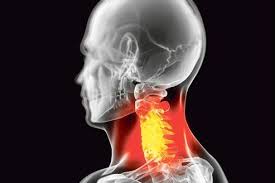 L'évolution de la douleur cervicale. Quelles Solutions Pour L Arthrose Cervicale