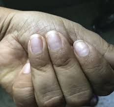 Image result for Beau lines feet