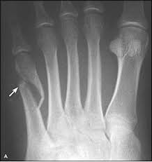 Fractures of proximal end of 5th metatarsal mostly unite without any problem. Metatarsal Fractures Physiopedia