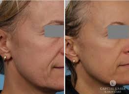 Clear + Brilliant® Laser Chevy Chase, MD