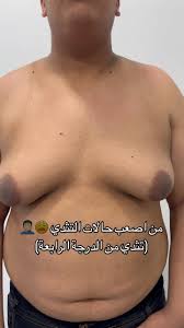 من اصعب حالات التثدي.. تثدي من الدرجة الرابعة و هنا يكون شكل الثدي للرجل  شبيه بالنساء., المراجع كان محرج جداً من هذا الموضوع و ما يكدر يلبس الملابس  براحته.. الحمدلله كدرنا نخلصه من هاي الحالة و نرجعله ...