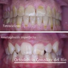 We did not find results for: Dientes Amarillos Conoce Sus Causas Y Soluciones Ortodoncia Gonzalez Del Rio