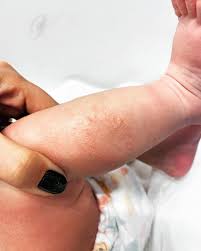 Image result for Eczema nummulare