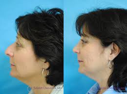 Rhinoplasty In 2020 Rhinoplasty Nose Surgery Nose