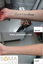 Each session can cost anywhere from $200 to $500, and most tattoos will require more than one session to remove, particularly large tattoos or tattoos featuring turquoise dye. Laser Tattoo Removal In New Jersey Soma Skin Laser
