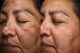 Image result for Melasma
