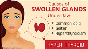 Swollen Lymph Nodes In Neck On One Side Swollen Lymph Nodes Lymph Nodes Glands Swollen