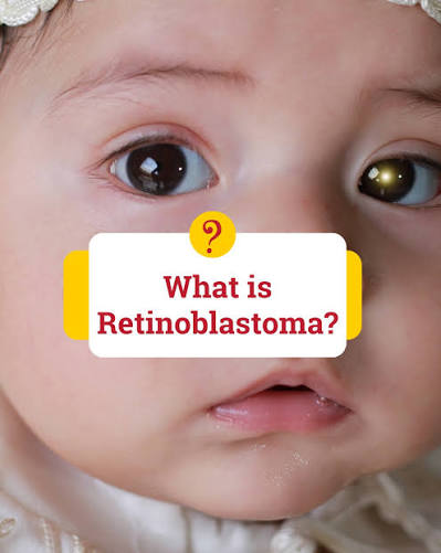 Retinoblastoma