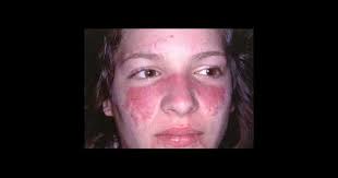 Was Ist Kutaner Und Systemischer Lupus Erythematodes