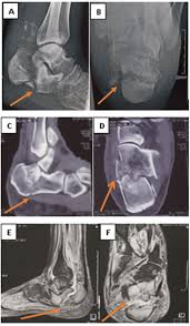 Image result for Calcaneus Compression Fracture