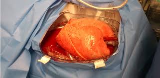 How will a transplant change my life? World First Lungs Awaiting Transplant Preserved 11 Hours Outside Body Healthmanagement Org