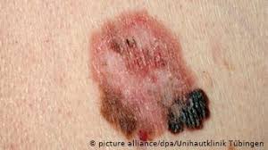 Unfortunately, marmur would experience skin cancer again. When Beauty Spots Turn Dangerous Science In Depth Reporting On Science And Technology Dw 15 05 2015
