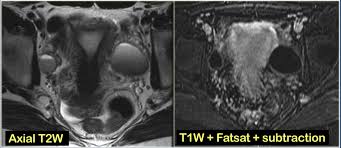 A recent study evaluated the relationship between polycystic ovarian syndrome (pcos), long or irregular periods, and ovarian cancer risk. The Radiology Assistant Ovarian Cystic Lesions