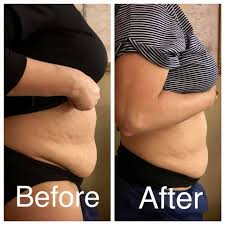 Cryo t shock and coolsculpting use extreme temperatures to kill fat cells (adipose). Check Out Our Cryo T Shock Aculaser Treatment Center Facebook