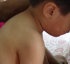 What does branny desquamation mean? Measles Rubeola Morbill Dermatology Advisor