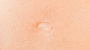 The tb vaccine scar usually starts with a swelling at the site of the injection. Smallpox Vaccine Scar Why It Happens