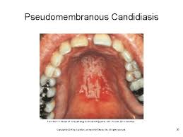 Maybe you would like to learn more about one of these? Chapter 17 Oral Pathology Copyright 2015 By Saunders