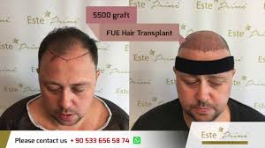 Our team of experts have done more than 10 000 hair transplants in our fully equipped hospitals in sweden and turkey. Our Client Review Este Prime Hair Transplant Clinic Istanbul Turkey Youtube