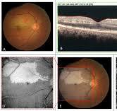Multimodal imaging for paracentral acute maculopathy; the ...