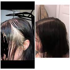Hair loss is not usually anything to be worried about, but occasionally it can be a sign of a medical some types of hair loss are permanent, like male and female pattern baldness. The Pic On The Left Was About 6 Mo Ago And The Right Was Today I Started Losing Tons Of Hair When I Got On The Pill After Consulting W My