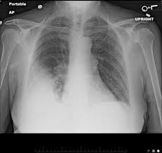 Legionnaires' disease is a severe, often lethal, form of pneumonia. Legionella Pneumonia When To Suspect Diagnostic Considerations And Treatment Strategies For Hospital Based Clinicians Springerlink