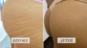 You see, when skin stretches, there are only certain areas from which the stretching occurs. Tattoo Artist Hides Stretch Marks With Skin Colored Ink Before And After Photos Allure