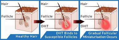 This may be due to the progression of your hair loss before. Low Dose Dutasteride Male Pattern Hair Loss Treatment Trial