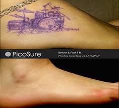 Treatment methods include injection with steroid such as kenalog, excision with. Picosure Archives O Neill Plastic Surgery