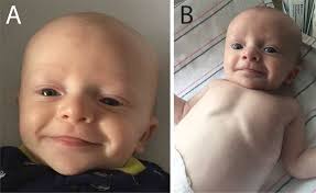 Congenital Chylothorax as the Initial Presentation of PTPN11-Associated  Noonan Syndrome