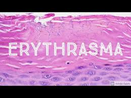 Image result for Erythrasma