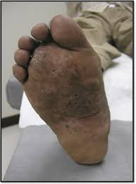 Madura foot , also called maduromycosis , or mycetoma , fungus infection, usually localized in the foot but occurring occasionally elsewhere on the body, apparently resulting from inoculation into a scratch. Non Invasive Management Of Madura Foot With Oral Posaconazole And Ciprofloxacin In The American Journal Of Tropical Medicine And Hygiene Volume 91 Issue 6 2014