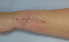 Check spelling or type a new query. Tattoo Removal Harley Plastic Surgery