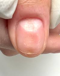 Image result for Onychotillomania feet