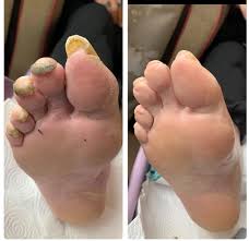 Image result for Onychogryphosis feet