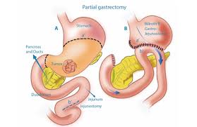 Here are the most common signs and symptoms of stomach cancer. Warning Signs Of Stomach Cancer Vaidam Com