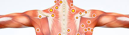 Myofascial Pain Syndrome Compensation Claim Blb Solicitors