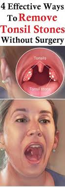 This gives a sudden pleasant sensation, while on the other hand the salt water and its particles push out the tonsil stone present in the deep tonsil crypt. Pin On Tonsil Remedies