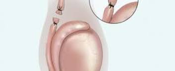 Image result for Vasectomy