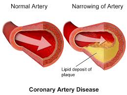 We did not find results for: Coronary Artery Disease Ecp Malaysia