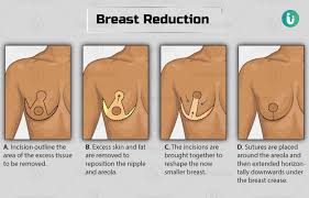 Maybe you would like to learn more about one of these? Breast Reduction Surgery Female Gynecomastia Surgery Male Procedure Purpose Results Cost Price