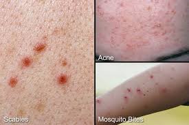 Image result for scabies symptoms