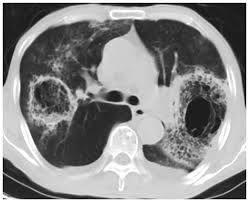 Rhizopus species are the most common causative organisms. Ct Image Of Lung With Pulmonary Mucormycosis The Bilateral Lungs Show Download Scientific Diagram