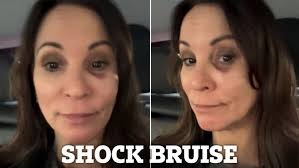 Loose Women star faints and is left with nasty black eye