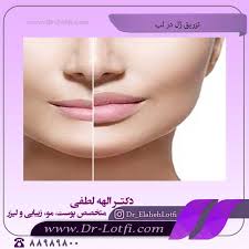 تزریق ژل لب و آشنایی با انواع مدل های آن + عکس قبل و بعد