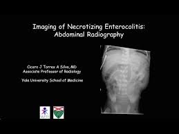 Image result for Necrotizing Enterocolitis