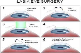 Custom lasik up to $2,140/eye. How Much Does Laser Eye Surgery Cost In India Vaidam Com