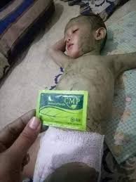 Demam yang tidak berhubungan dengan kondisi kesehatan yang serius biasanya disebabkan oleh: Cmp Hwi Si Buah Hati Demam Suhu Badan Panas Facebook