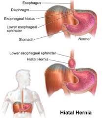 What are the tests for hiatal hernia? answered by dr. Weightlifting Guide Nissen Fundoplication For Hiatal Hernia Scary Symptoms